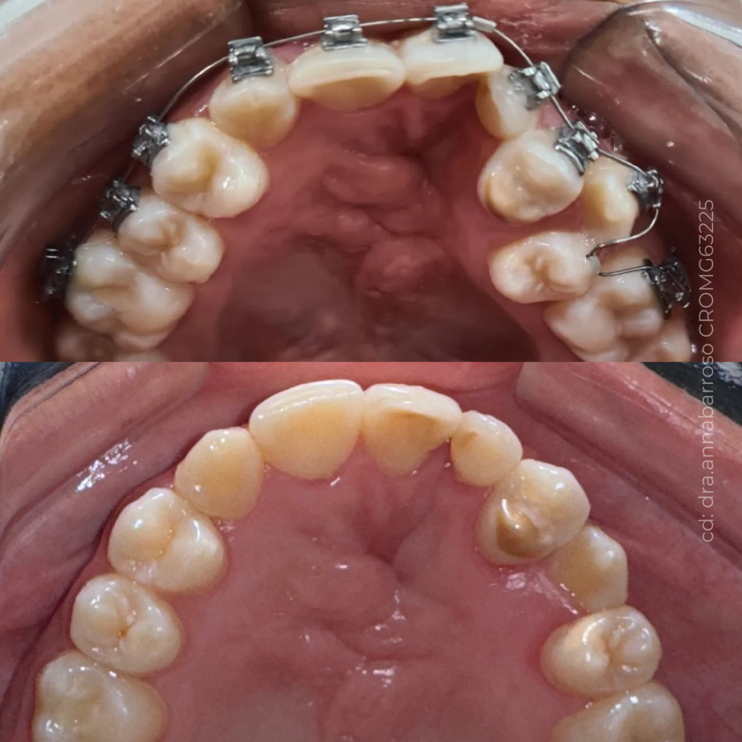 Antes e Depois 40